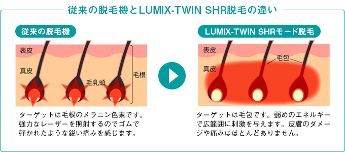 従来の脱毛機とLUMIX-TWIN SHR脱毛の違い
