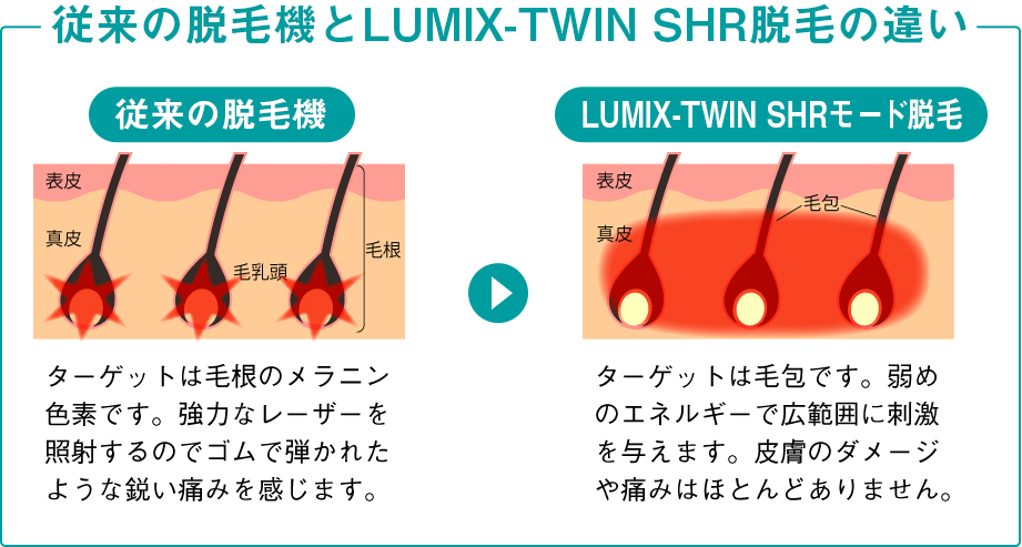 従来の脱毛機とLUMIX-TWIN SHR脱毛の違い ターゲットは毛根のメラニン色素です。強力なレーザーを照射するのでゴムで弾かれたような鋭い痛みを感じます。ターゲットは毛包です。弱めのエネルギーで広範囲に刺激を与えます。皮膚のダメージや痛みはほとんどありません。